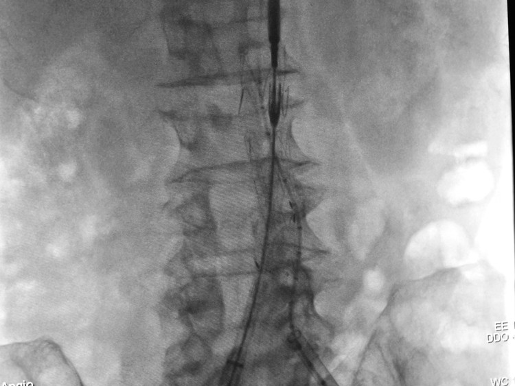 Hình ảnh stent graft với vai trò như một màng bọc vững chắc, giúp gia cố đoạn mạch tổn thương