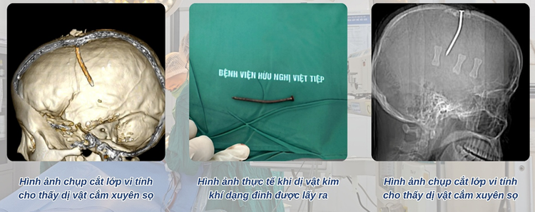 Hình ảnh đinh sắt đâm xuyên sọ bệnh nhân trên phim chụp - Ảnh BVCC