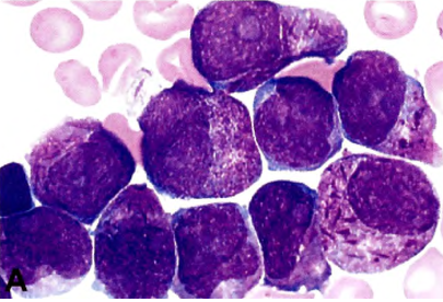 Hình ảnh tế bào blast thể tiền tủy bào - Ảnh BSCC