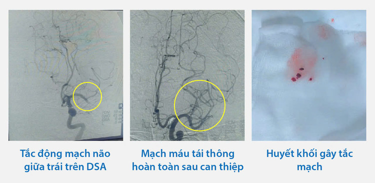 Huyết khối tắc tĩnh mạch của bệnh nhân đã được can thiệp kịp thời - Ảnh BVCC