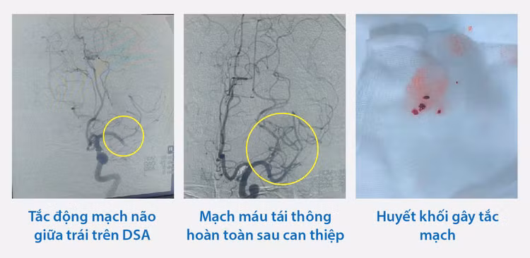 Huyết khối tắc tĩnh mạch của bệnh nhân đã được can thiệp kịp thời - Ảnh BVCC Huyết khối tắc tĩnh mạch của bệnh nhân đã được can thiệp kịp thời - Ảnh BVCC