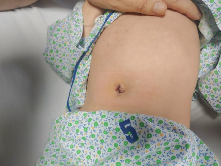 Kỹ thuật nội soi một lỗ điều trị nang ống mật chủ không có sẹo cho bệnh nhi người Australia