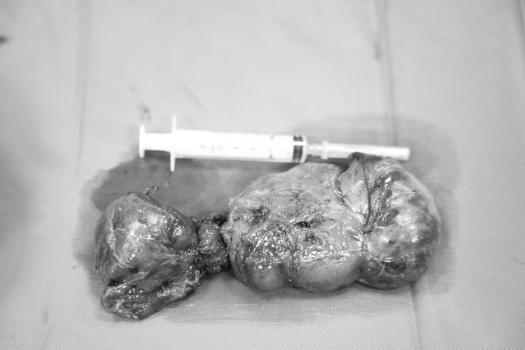 Khối u tuyến giáp thòng trung thất được lấy bỏ thành công - Ảnh BVCC