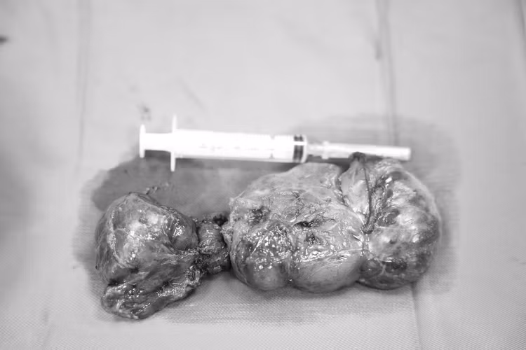 Khối u tuyến giáp thòng trung thất được lấy bỏ thành công - Ảnh BVCC