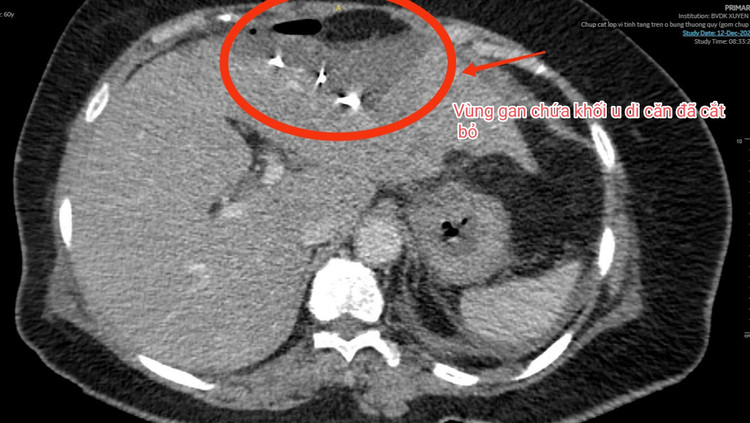 Ảnh khối u di căn gan đã được cắt bỏ trên phim chụp Ảnh khối u di căn gan đã được cắt bỏ trên phim chụp