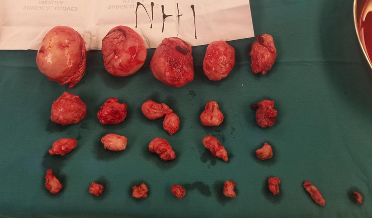 Các khối u xơ tử cung được lấy ra Các khối u xơ tử cung được lấy ra