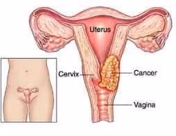 Biểu hiện của ung thư tử cung - Ảnh minh họa