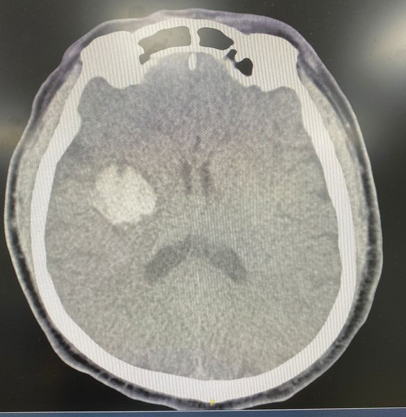 Hình ảnh xuất huyết não trên phim chụp - Ảnh BVCC