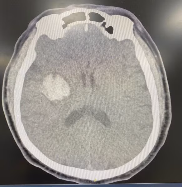 Hình ảnh xuất huyết não trên phim chụp - Ảnh BVCC