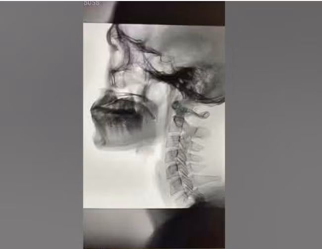 Chẩn đoán rối loạn nuốt bằng nghiên cứu nuốt qua video nội soi huỳnh quang