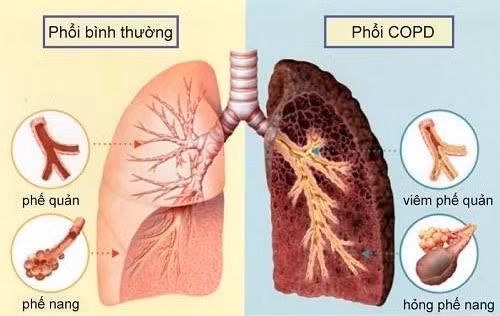 Phổi ở người bình thường và phổi ở người mắc bệnh COPD có 2 vị trí tổn thương chính là viêm ở đường thở (khí-phế quản) và phá hủy nhu mô phổi (khí phế thũng)