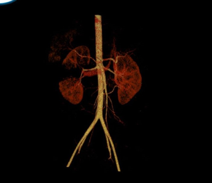 Thận vỡ sau chấn thương