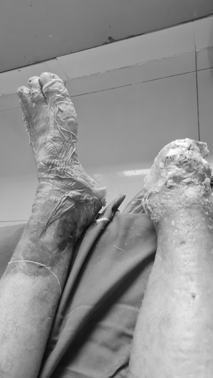 Nhiều bệnh nhân phải cắt cụt Nhiều bệnh nhân phải cắt cụt