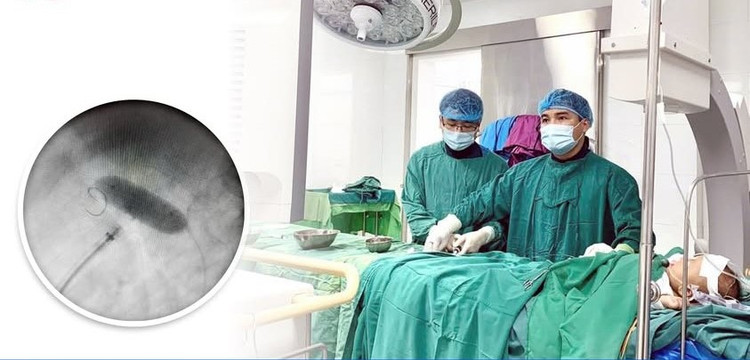 Can thiệp qua da điều trị hẹp eo động mạch chủ cho bệnh nhi 3 tuổi.