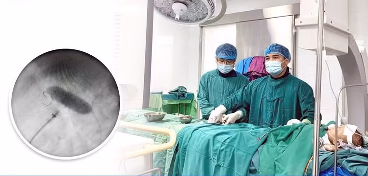 Can thiệp qua da điều trị hẹp eo động mạch chủ cho bệnh nhi 3 tuổi.