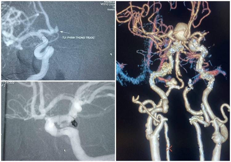 Hình ảnh các túi phình mạch não được kíp bác sĩ khoa Chẩn đoán hình ảnh can thiệp nút coil - Ảnh BVCC