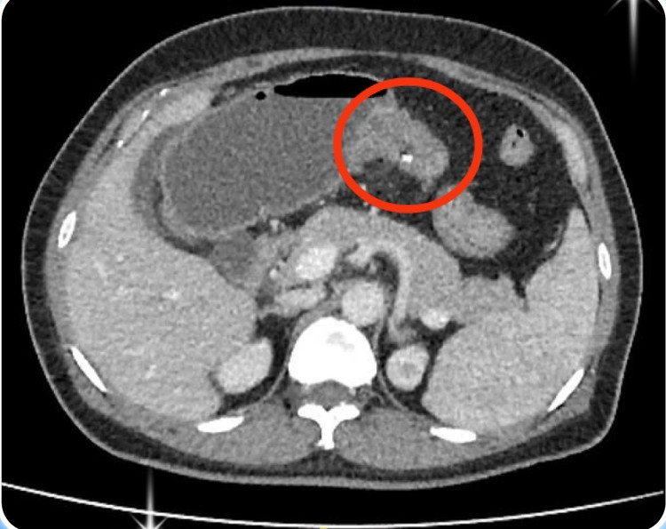 Hình ảnh CT khối u đại tràng - Ảnh BVCC