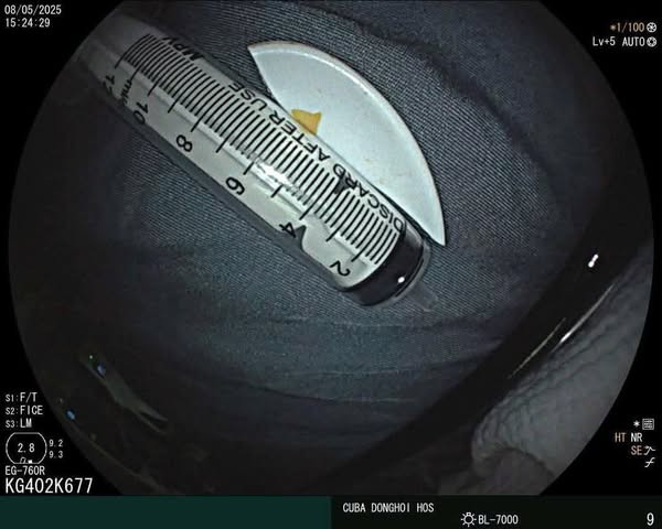 Mảnh thìa nhựa trong vùng mũi hầu - họng bệnh nhân được lấy ra - Ảnh BVCC