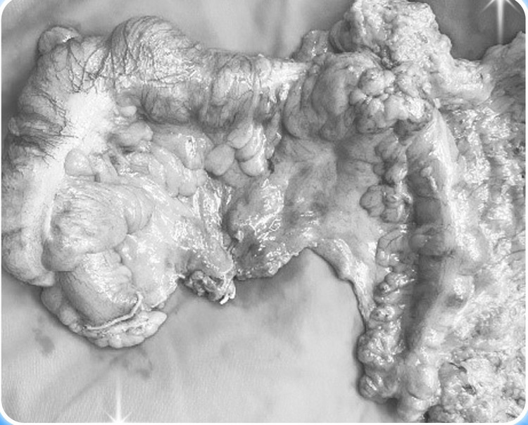 Khối ung thư được cắt bỏ - Ảnh bVCC