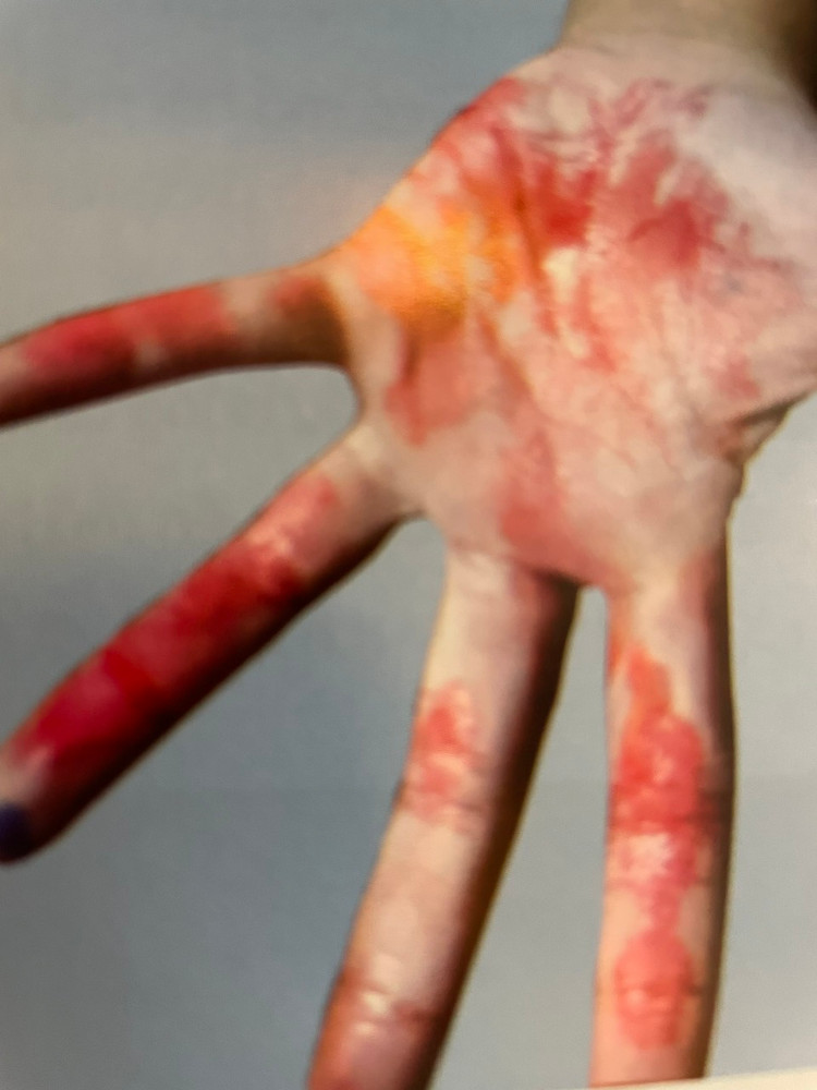 Cú sốc tinh thần khiến bé gái 7 tuổi bị hội chứng mồ hôi máu - Ảnh BSCC