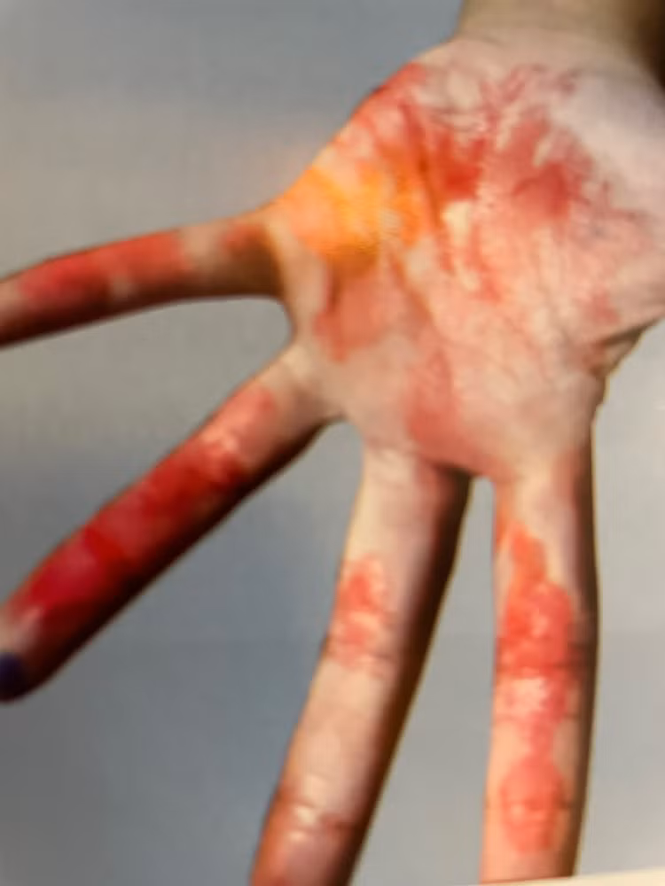 Cú sốc tinh thần khiến bé gái 7 tuổi bị hội chứng mồ hôi máu - Ảnh BSCC