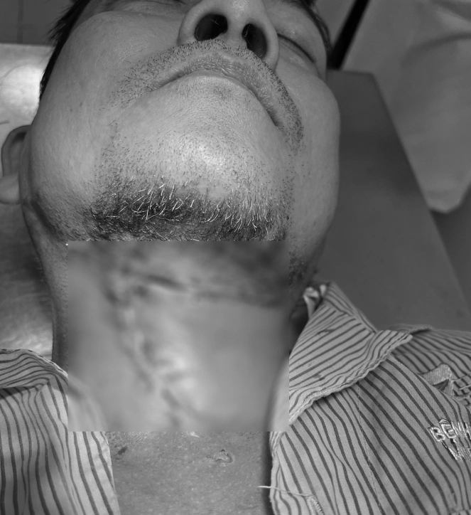 Bệnh nhân sau phẫu thuật - Ảnh: BVCC