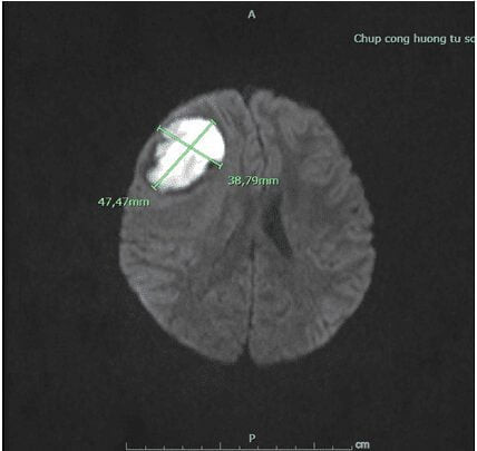 Khối áp xe não trên phim cộng hưởng tử