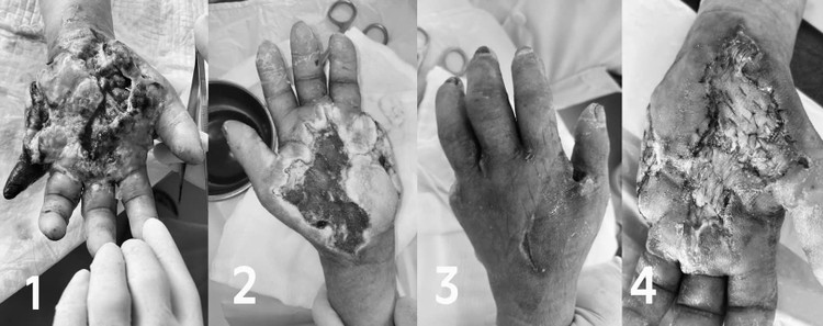 Tay hoại tử chỉ từ vết ngứa - Ảnh BVCC