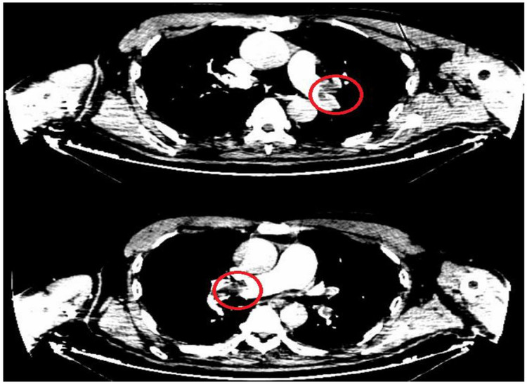 Hình ảnh huyết khối động mạch phổi cả 2 bên của bệnh nhân. - Ảnh BVCC