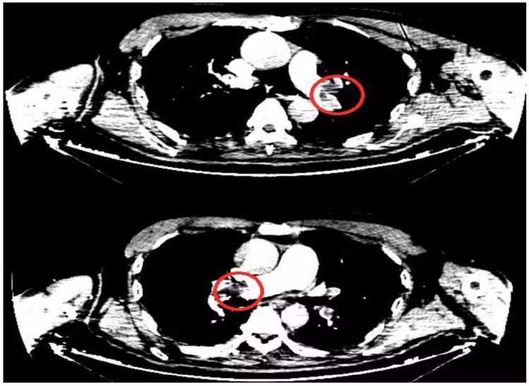 Hình ảnh huyết khối động mạch phổi cả 2 bên của bệnh nhân. - Ảnh BVCC Hình ảnh huyết khối động mạch phổi cả 2 bên của bệnh nhân. - Ảnh BVCC