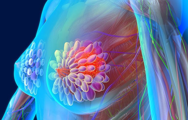 Cách bảo vệ sức khỏe vòng một, giảm nguy cơ ung thư tuyến vú - Ảnh minh hoạ