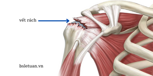 Rách chóp xoay - Ảnh BSCC