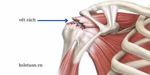 Rách chóp xoay - Ảnh BSCC