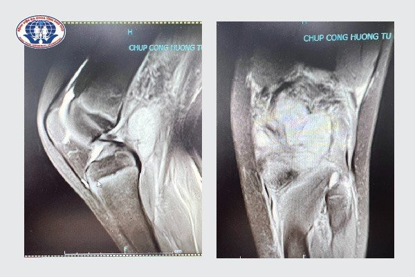 Hình ảnh chụp cộng hưởng từ vùng khoeo chân bị áp xe của bệnh nhi B.T.P