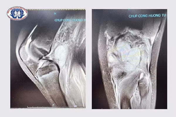 Hình ảnh chụp cộng hưởng từ vùng khoeo chân bị áp xe của bệnh nhi B.T.P