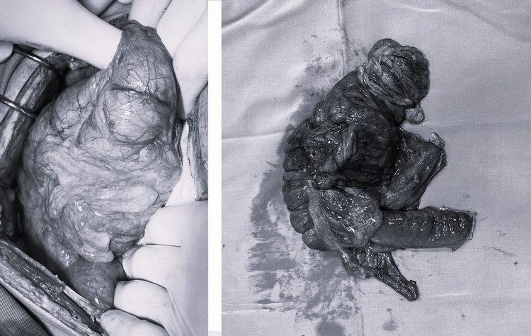 U đại tràng gây tắc ruột đã được lấy bỏ - ảnh BVCC