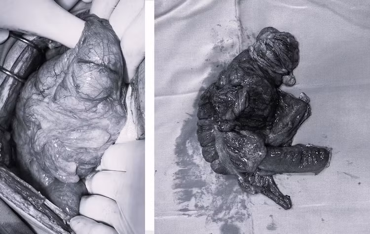 U đại tràng gây tắc ruột đã được lấy bỏ - ảnh BVCC