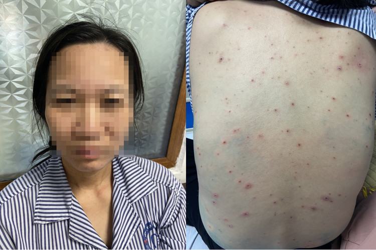 Tình trạng bệnh nhân V.T.O sau 04 ngày điều trị tích cực