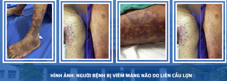 Ăn nem chua, quý ông 42 tuổi bị viêm màng não do liên cầu lợn - Ảnh BVCC Ăn nem chua, quý ông 42 tuổi bị viêm màng não do liên cầu lợn - Ảnh BVCC