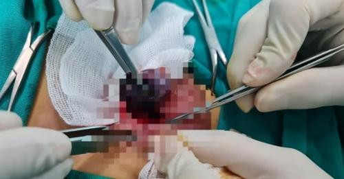 Nhiều trường hợp phải cắt bỏ tinh hoàn vì xoắn