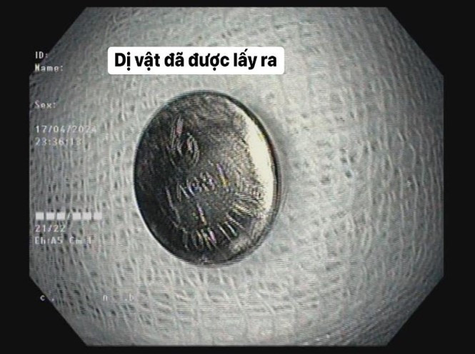 Dị vật được lấy ra khỏi dạ dày bệnh nhi - Ảnh: BVCC