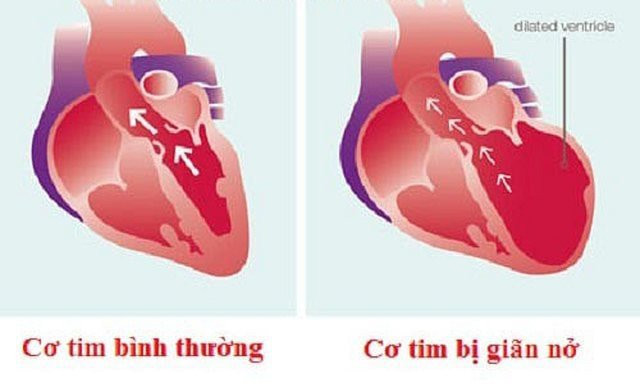 Biểu hiện của cơ tim giãn nở - Ảnh minh họa