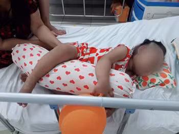 Bệnh nhi tay chân miệng nặng đã hồi phục ngủ ngon chuẩn bị xuất viện - ảnh BVCC