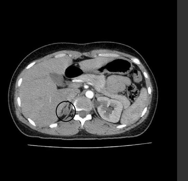 Hình ảnh u trên phim chụp - Ảnh BVCC