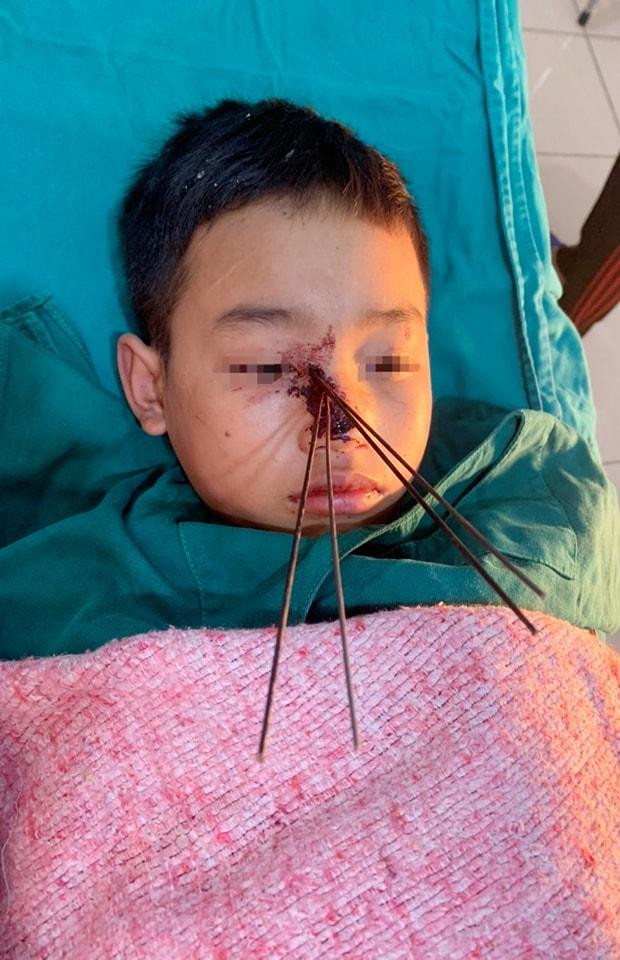 Trẻ bị 4 mũi tên đâm sâu giữa mặt.
