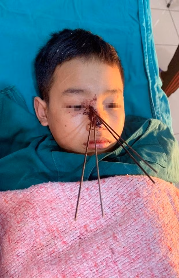Trẻ bị 4 mũi tên đâm sâu giữa mặt.