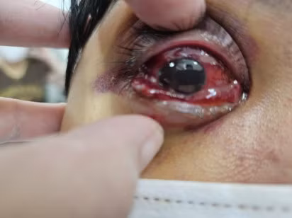 Mù sau tiêm filler ở nước ngoài, bệnh nhân về cầu cứu bác sĩ Việt Nam ảnh 1