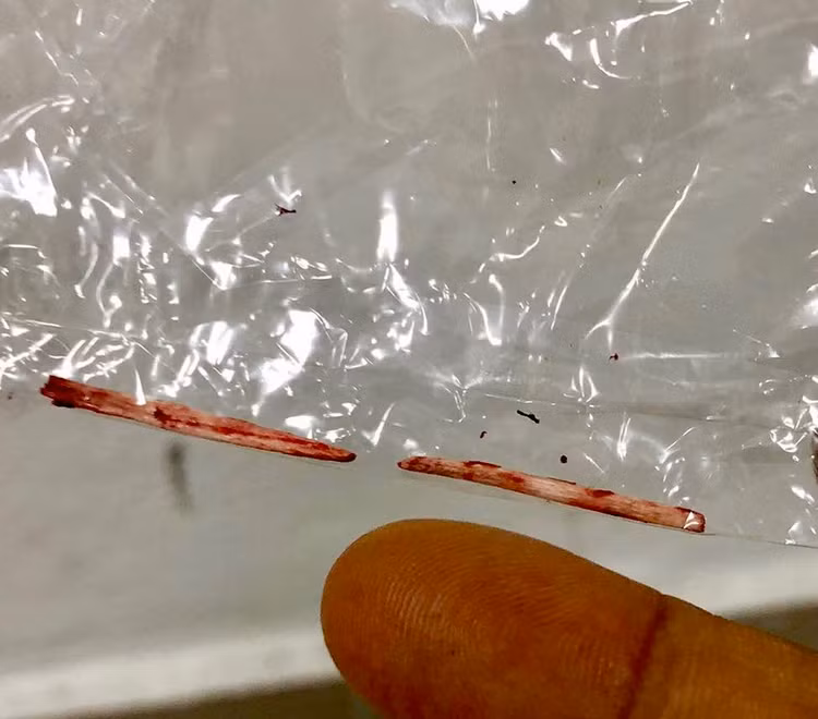 Xương cá được lấy ra sau phẫu thuật - Ảnh BVCC