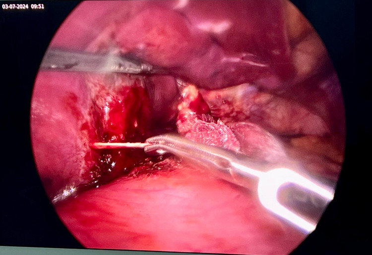 Hy hữu: Xương cá dài 4cm trong gan của nam thanh niên ảnh 2