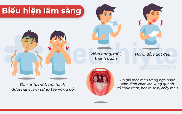 Biểu hiện của bệnh bạch hầu - Ảnh BSCC